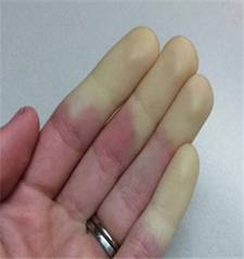 手指发白发紫